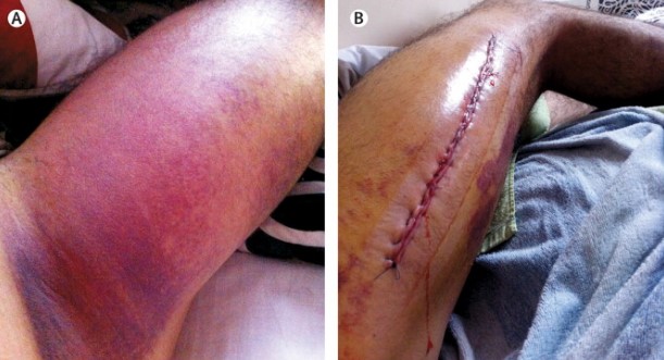 Acute Compartment Syndrome