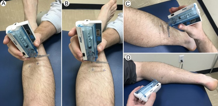 Chronic Compartment Syndrome