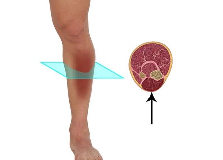 Compartment Syndrome